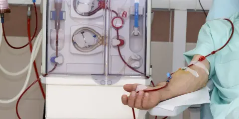 Pacjent podłączony do aparatu do dializy. Czerwone przewody doprowadzają krew do maszyny, która oczyszcza ją. To właśnie dializa co to jest w praktyce.