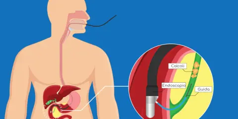 ERCP: endoscopio inserito per rimuovere calcoli che causano ostruzione coledoco.
