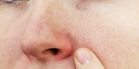 Gros plan sur un nez avec une légère rougeur autour des narines et des pores visibles. Un doigt effleure la peau.
