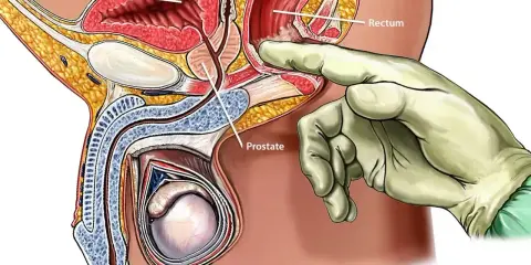 Badanie per rectum: palec w rękawiczce dotyka prostaty przez odbytnicę. Ważne badanie na prostatę.
