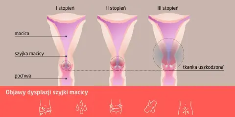 Grafika przedstawia stadia dysplazji szyjki macicy: I, II i III stopień, z zaznaczoną tkanką uszkodzoną w III stadium. Poniżej objawy: ból podczas stosunku, plamienia, ból brzucha, obfite miesiączki, podrażnienie pochwy.