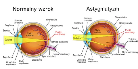 Porównanie budowy oka z normalnym wzrokiem i astygmatyzmem. Brak domowy sposób na astygmatyzm.