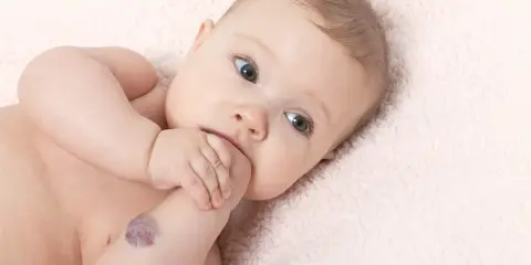 Bebé con un angioma en el brazo, mirando a la cámara con curiosidad.