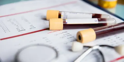 Wyniki badań wskazują, że mcv za wysokie. Obok leżą probówki z krwią i stetoskop.