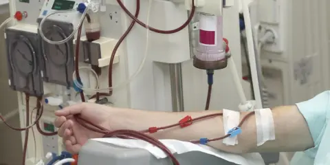 Dializa nerek jak długo można żyć? Pacjent podłączony do aparatury medycznej, krew krąży przez przewody.
