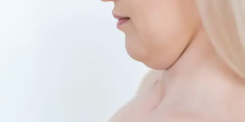 Primo piano del profilo di una donna con doppio mento, un'area che molte persone desiderano migliorare per capire come dimagrire sotto il mento.