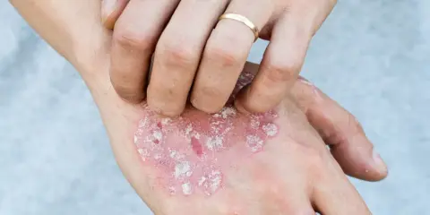 Main d'une personne se grattant des plaques rouges et squameuses, possiblement liées au psoriasis en goutte.