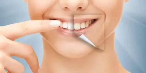 Ile kosztuje Hollywood Smile: kompletny cennik zabiegów w 2025 roku