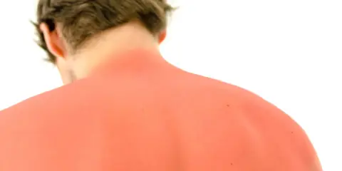 Schiena arrossata dal sole, un ricordo di una giornata intensa. Forse un po' di cefixoral per alleviare il bruciore.