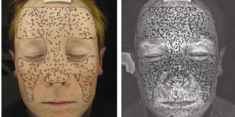 Confronto tra pelle senza crema solare (A) e pelle esposta a luce UV (B), evidenziando i danni solari.