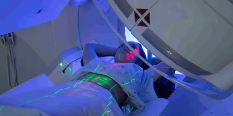 Pacjentka leży pod aparatem do radioterapii, na jej ciele widoczne są zielone i czerwone linie naprowadzające.