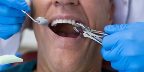 Ból po wyrwaniu zęba: ile trwa, co normą i kiedy do dentysty?