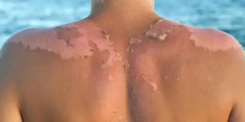 Piel descascarada por quemadura solar. Descubre cómo detener el peeling tras la insolación y aliviar tu piel.