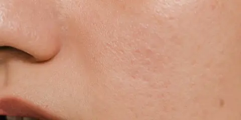 Pelle arrossata e screpolata, con piccole imperfezioni, tipica di un'ustione o un peeling chimico.