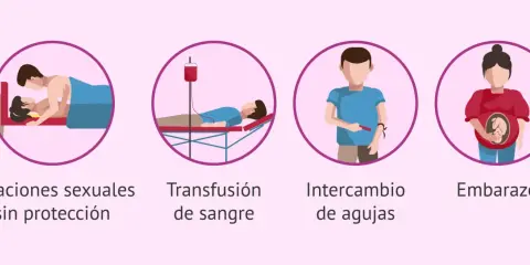 Ilustraciones muestran cómo se puede dar el contagio de clamidia: relaciones sexuales sin protección, transfusión de sangre, intercambio de agujas y embarazo.