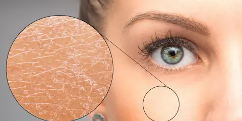 Gros plan sur un œil et une partie du visage d'une femme, avec un zoom montrant la **peau sèche du visage** craquelée et une autre zone plus lisse.