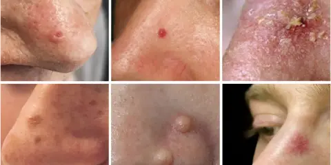 Divers types de lésions cutanées sur le nez, dont un bouton dans le nez douloureux que faire.