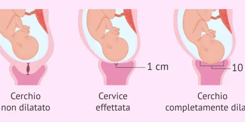 Illustrazione del travaglio: cervice non dilatata, dilatata di 1 cm e completamente dilatata (10 cm). Il cerchiaggio cervicale è una procedura per sostenere una cervice debole.
