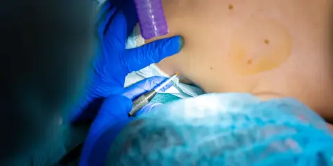 Lekarz pobiera próbkę tkanki. Czy biopsja oznacza raka? Nie zawsze, to ważny krok diagnostyczny.