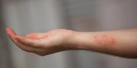 Poignet présentant une dartre cutanée rouge et irritée.