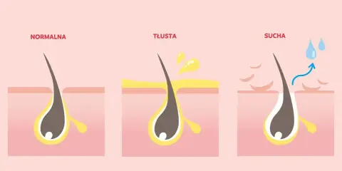 Ilustracja pokazuje normalną, tłustą i suchą skórę głowy. Tłusta skóra może powodować swędzenie i wypadanie włosów.