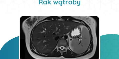 Przekrój tomografii komputerowej wątroby z widocznym guzem.