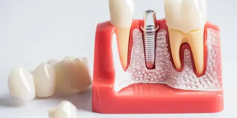 Ból po wyrwaniu ósemki: Ile trwa, co jest normą i kiedy do dentysty?