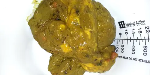 Feci oleose, di colore giallo-verdastro, con residui visibili e una consistenza untuosa. Accanto, una scala graduata.