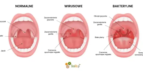 Ilustracja porównująca zdrowe gardło z gardłem w anginie wirusowej i bakteryjnej.
