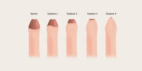 Ilustracja pokazuje, jak wygląda penis w różnych stadiach stulejki, od normy do stadium 4.