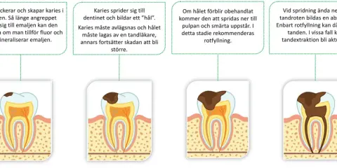 Bilden visar hur karies utvecklas i en tand, från emaljen till pulpan och roten. Om karies inte behandlas kan det leda till abscess och tandutdragning.