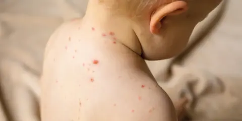Enfant atteint de varicelle, avec des boutons rouges sur le dos et le cou. Conseils pour aider à comment faire sécher les boutons de varicelle rapidement.
