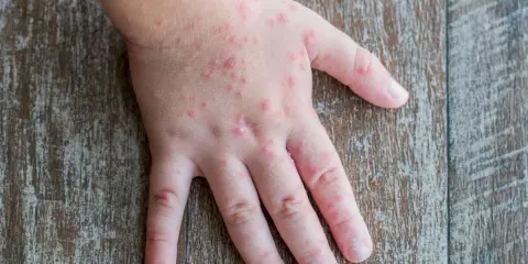 Mani di bambini con eruzioni cutanee rosse, simili a quelle che a volte compaiono su bocca e piedi.
