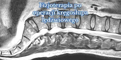 Obraz rezonansu magnetycznego kręgosłupa lędźwiowego, ilustrujący proces rehabilitacji po operacji.