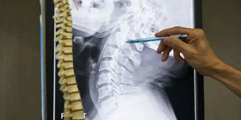 Un medico indica una radiografia della colonna vertebrale cervicale, evidenziando possibili metastasi ossee.