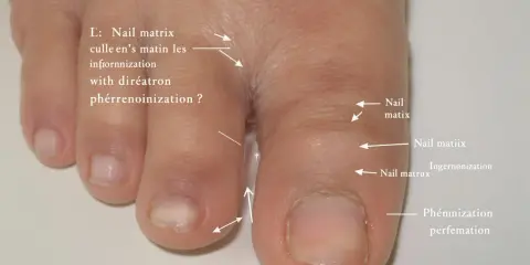 Gros orteil avec ongle incarné. Le prix d'une consultation podologue pour ce problème est indiqué.