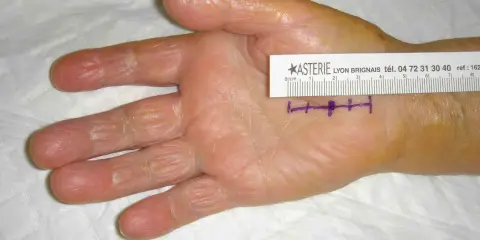 Main de patiente avec marques violettes et règle millimétrée, indiquant la zone d'intervention pour un syndrome du canal carpien.