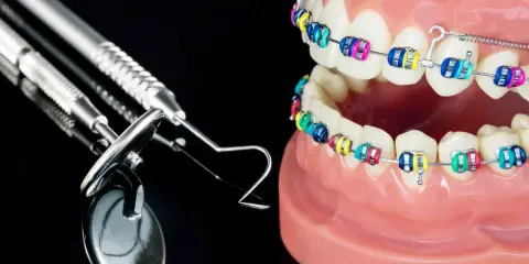 Model szczęki z kolorowym aparatem ortodontycznym i narzędziami dentystycznymi. Idealne do ćwiczeń na tyłozgryz.