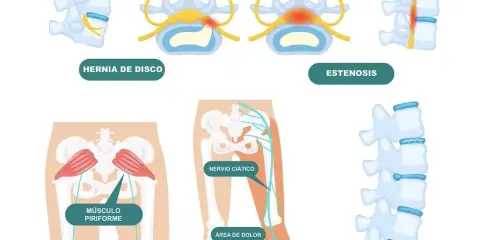 ¿Es ciática? Reconoce síntomas, causas y cuándo actuar
