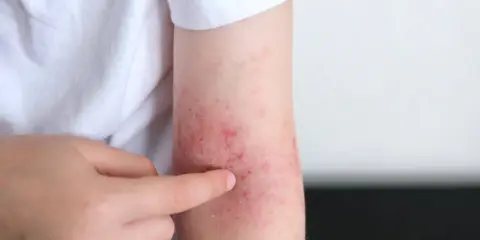 Un bras montre des rougeurs et des irritations, signe d'un possible stress peau.