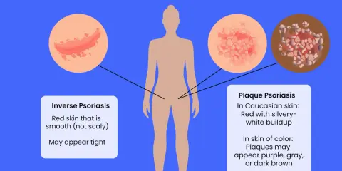 Illustration des types de psoriasis génital, y compris le psoriasis inversé et le psoriasis en plaques, qui peuvent affecter le pénis.