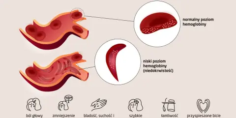 Objawy niskiej hemoglobiny: ból głowy, bladość, zmęczenie. Co jeść, by podnieść poziom? Ilustracja pokazuje zdrowe i chore krwinki.