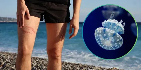 Gamba con segni rossi, forse da medusa. Immagine di una medusa blu e bianca. Cosa fare se ti tocca una medusa.