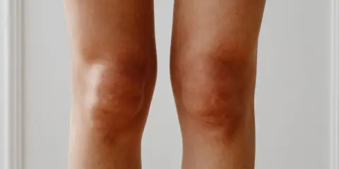 Ginocchia con pelle abbronzata e leggermente secca, evidenziando le pieghe naturali.