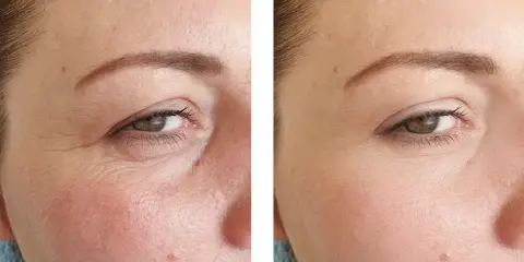Vorher-Nachher-Vergleich zeigt die beeindruckende **Retinol Wirkung** auf die Haut. Falten sind sichtbar reduziert, die Haut wirkt glatter und jugendlicher.