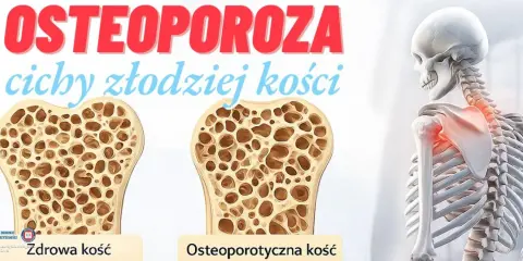 Osteoporoza to nie rak kości, lecz cichy złodziej kości. Porównanie zdrowej i osteoporotycznej kości.