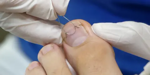 Application d'une orthonyxie sur un ongle incarné. Des mains gantées ajustent un fil métallique pour corriger la courbure de l'ongle.