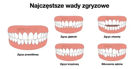 Ilustracje pokazują różne wady zgryzu: prawidłowy, głęboki, otwarty, krzyżowy i stłoczenia zębów.