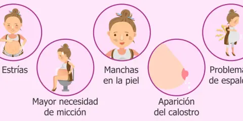 Ilustración de síntomas de embarazo: estrías, mayor necesidad de micción, manchas en la piel, aparición del calostro y problemas de espalda.