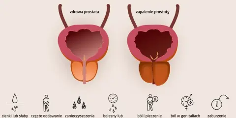 Ilustracja porównuje zdrową prostatę z zapaloną, pokazując objawy zapalenia prostaty: słaby strumień moczu, ból, pieczenie i zaburzenia erekcji.